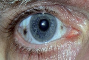 Image of an eye with black spots 