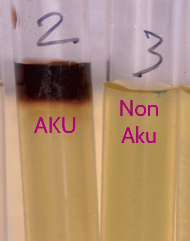 Image of normal coloured urine and urine which has turned black due to AKU