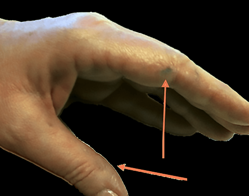 Hand preNitisinone