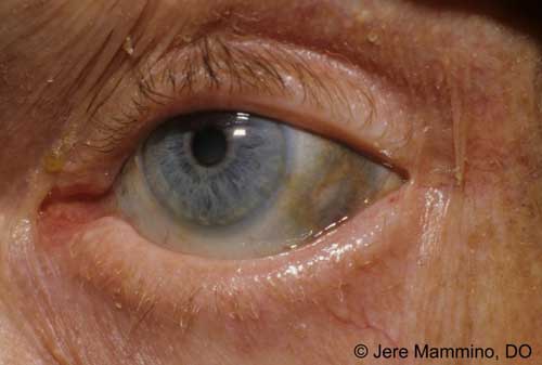 eye